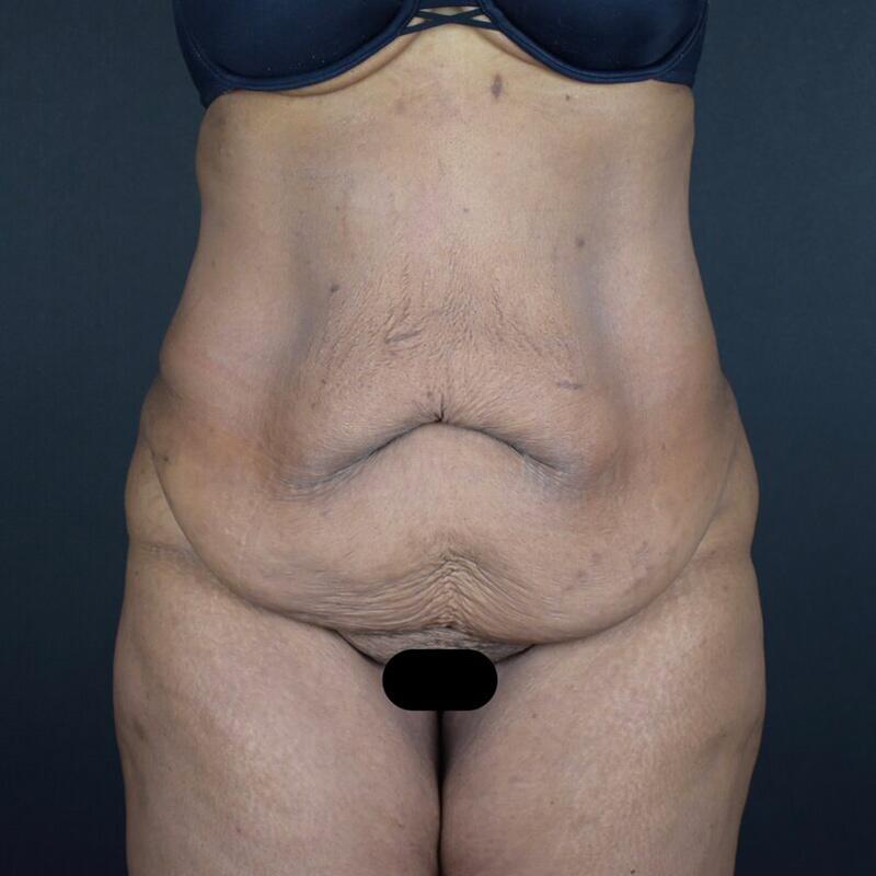 Abdominoplasty Without Liposuction Before & After Image