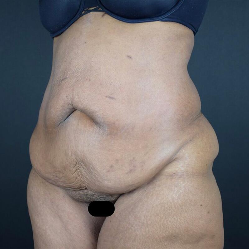 Abdominoplasty Without Liposuction Before & After Image