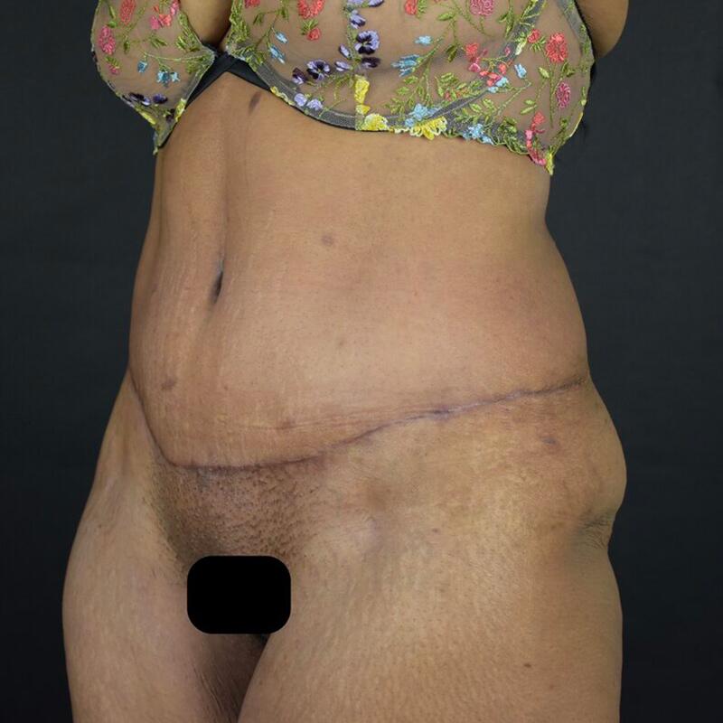 Abdominoplasty Without Liposuction Before & After Image