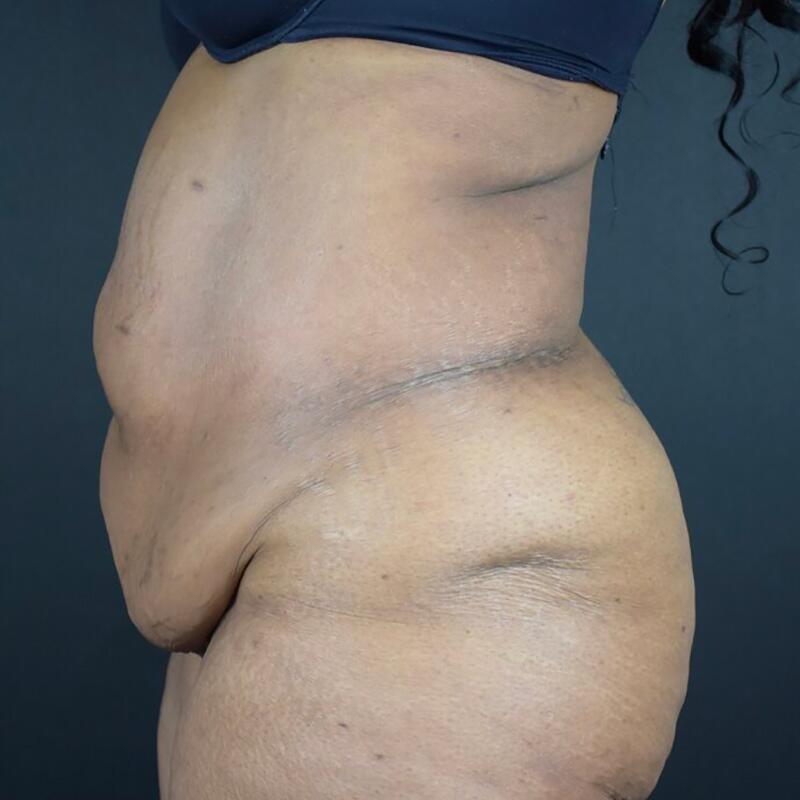 Abdominoplasty Without Liposuction Before & After Image