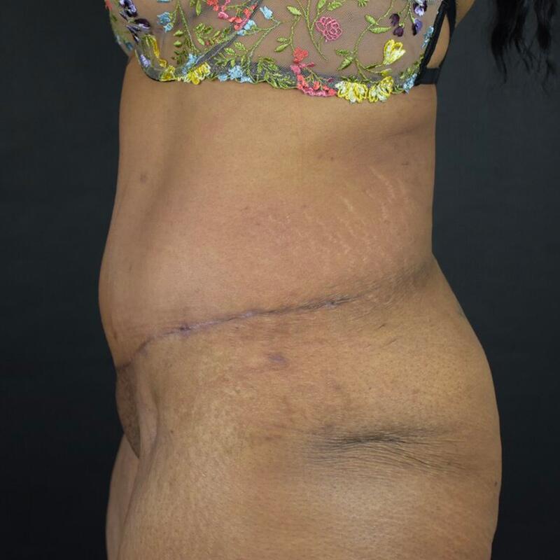 Abdominoplasty Without Liposuction Before & After Image