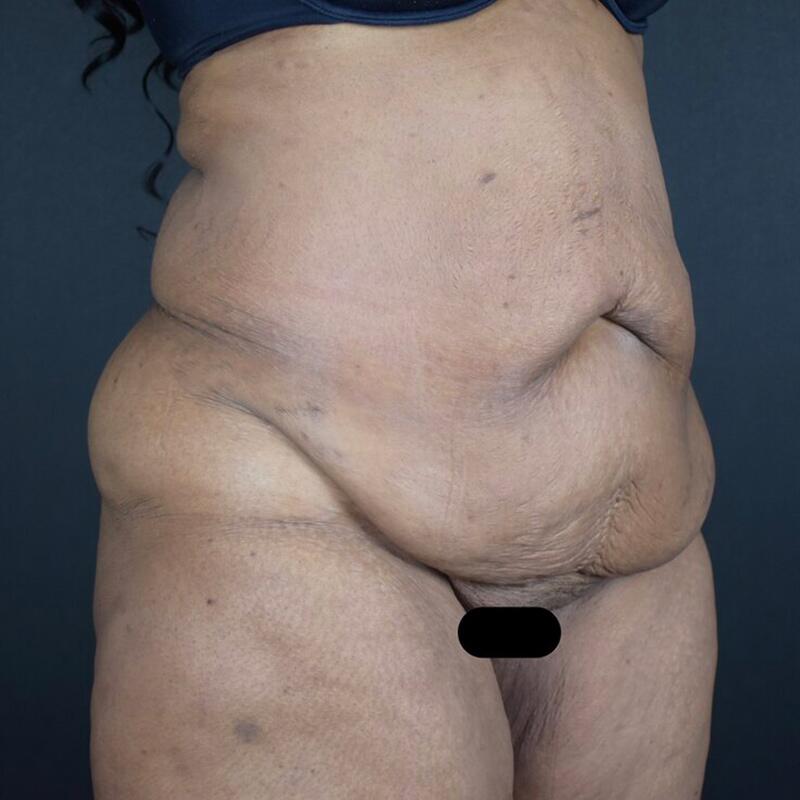 Abdominoplasty Without Liposuction Before & After Image