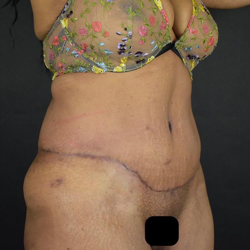 Abdominoplasty Without Liposuction Before & After Image