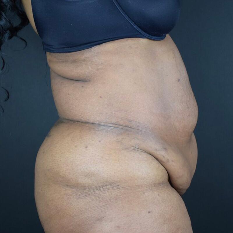 Abdominoplasty Without Liposuction Before & After Image