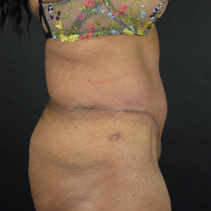 Abdominoplasty Without Liposuction Before & After Image